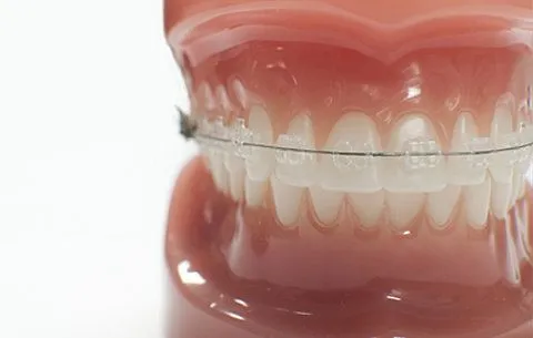 Servicios: Brackets Transparentes - Dr. Rudin