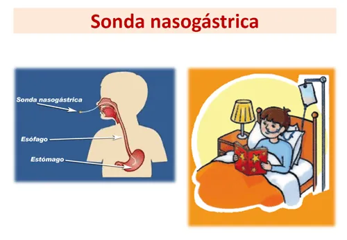 Sonda nasogástrica en enfermedades metabólicas | Guía metabólica