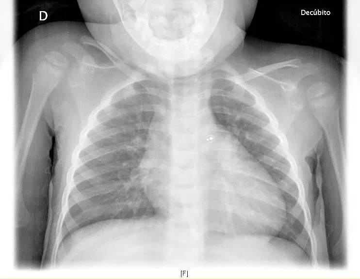 Tecnicos Radiologos: Radiografia toracica pediatrica: Dispositivo ...