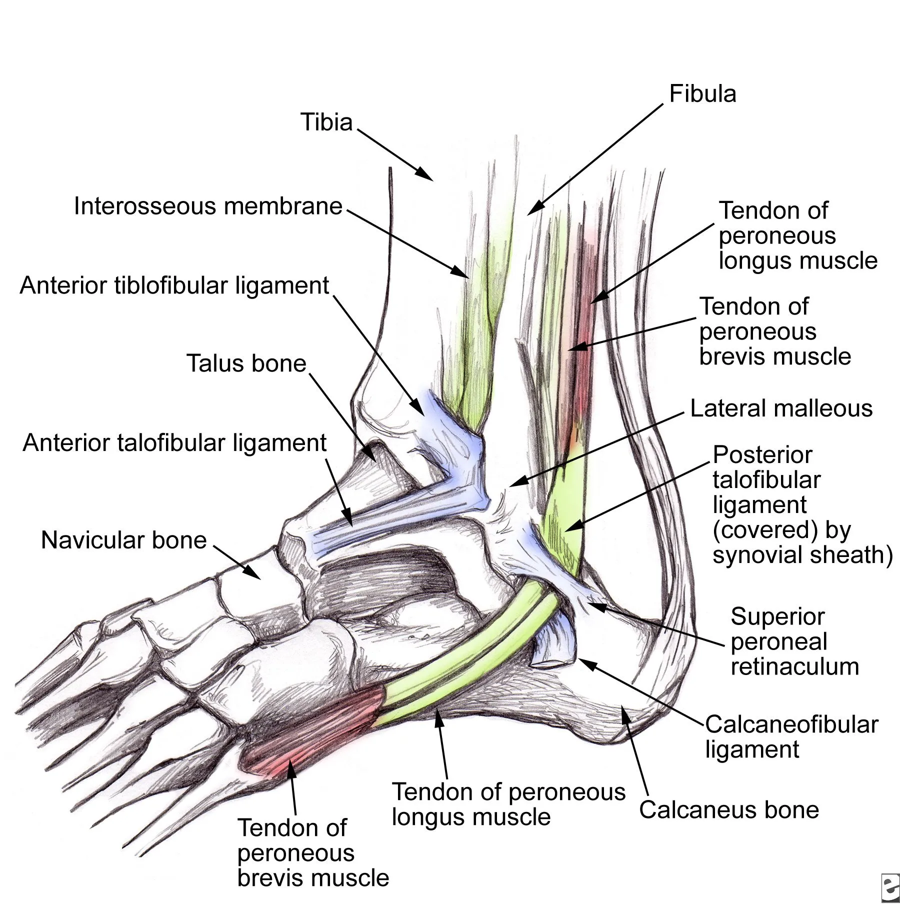 Tendinitis peroneos