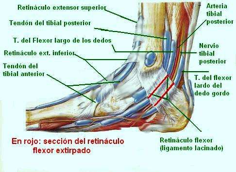 Tendinitis del tibial posterior