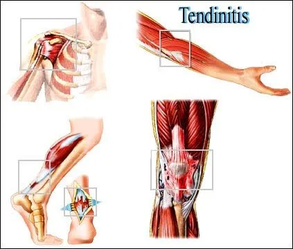 Terapeuta_Masajes¡YA!: TENDINITIS