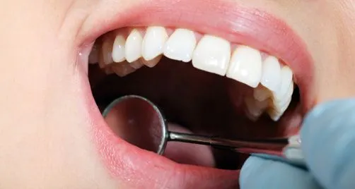 Qué tipos de limpieza dental puedo hacerme? | ComparaDentistas ...