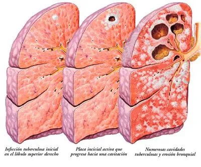 Tuberculosis - Enfermedades - ZonaMedica.