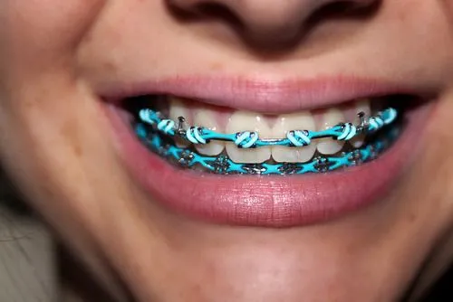 Braces Colors: Design Your Braces Colors