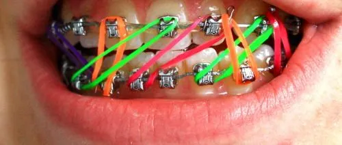 my posts Braces neon color katlh •