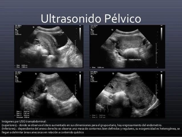 tumor-de-senos-endodrmicos-4- ...