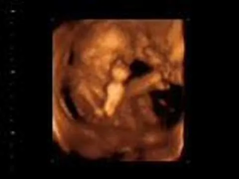  ... 3D tiempo real (4D) de un bebe a las 18 semanas de gestacion