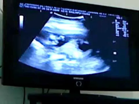 ultrasonido+s+meses on Veengle