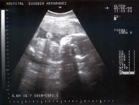 Ultrasonido de niña de 4 meses - Imagui