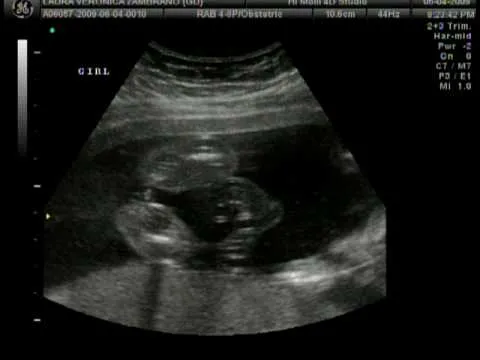 Imagenes de ultrasonidos de niña - Imagui