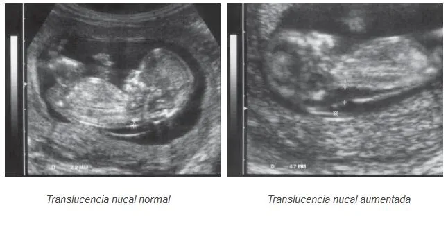 Valores y resultados de la medición del pliegue o translucencia ...