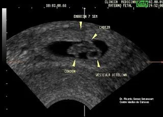 Como se ve un bebé de 7 semanas de gestación - Imagui
