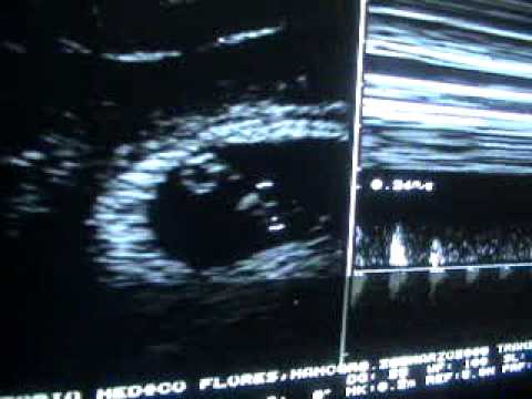  ... weeks- Ultrasonido transvaginal de Embarazo de 6.4 semanas